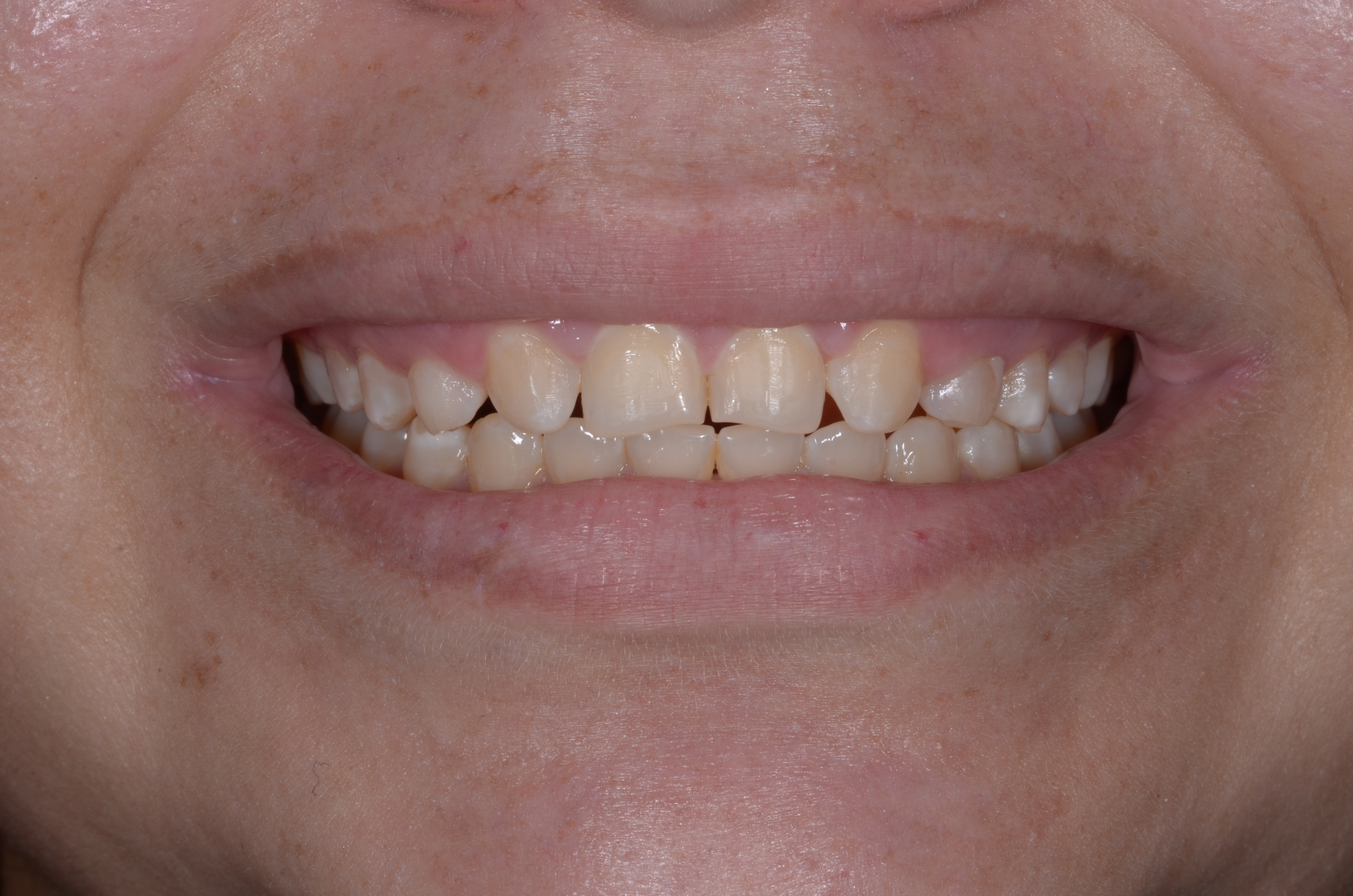 Antes del tratamiento con disilicato