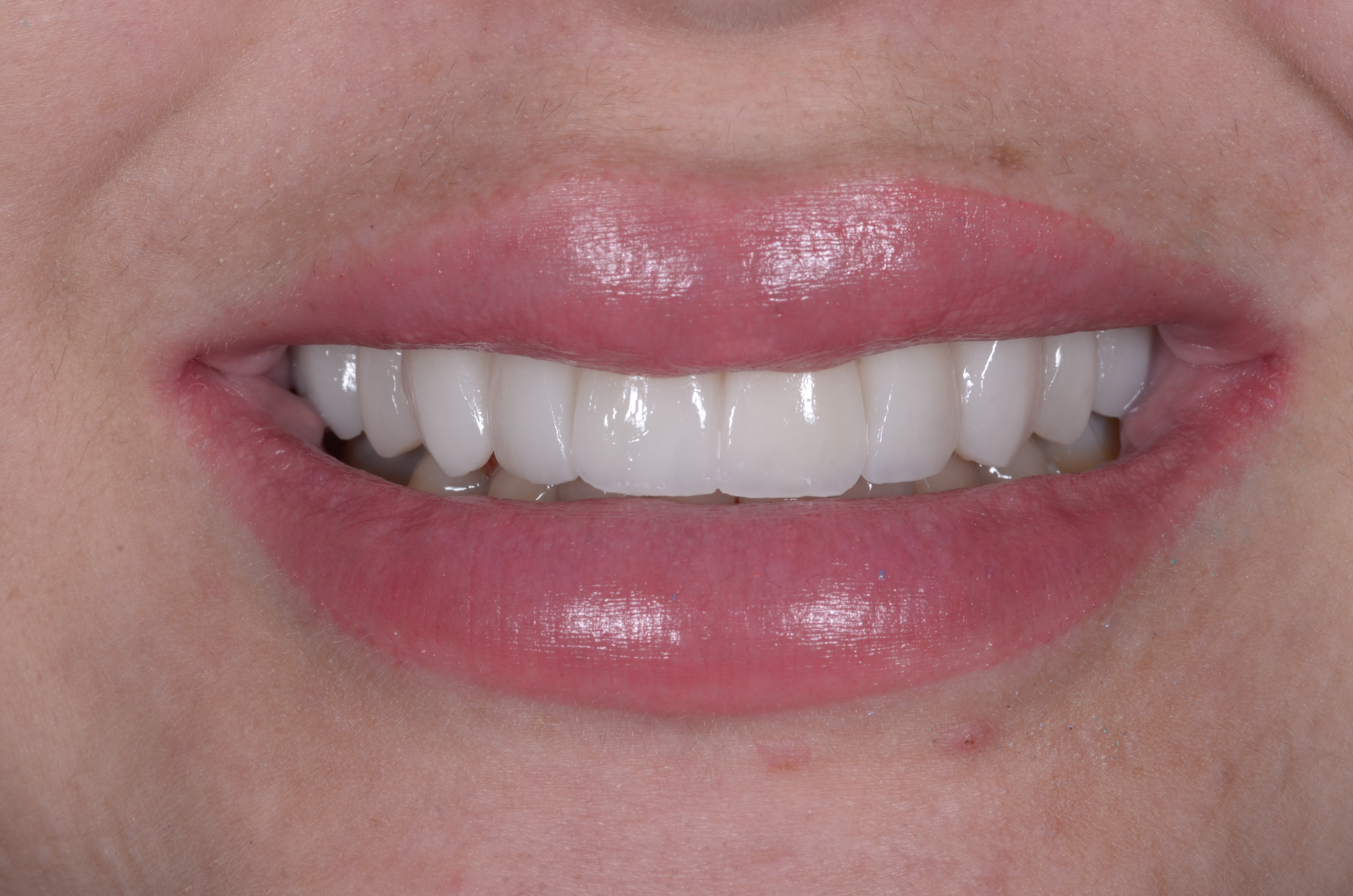 Diseño en Disilicato