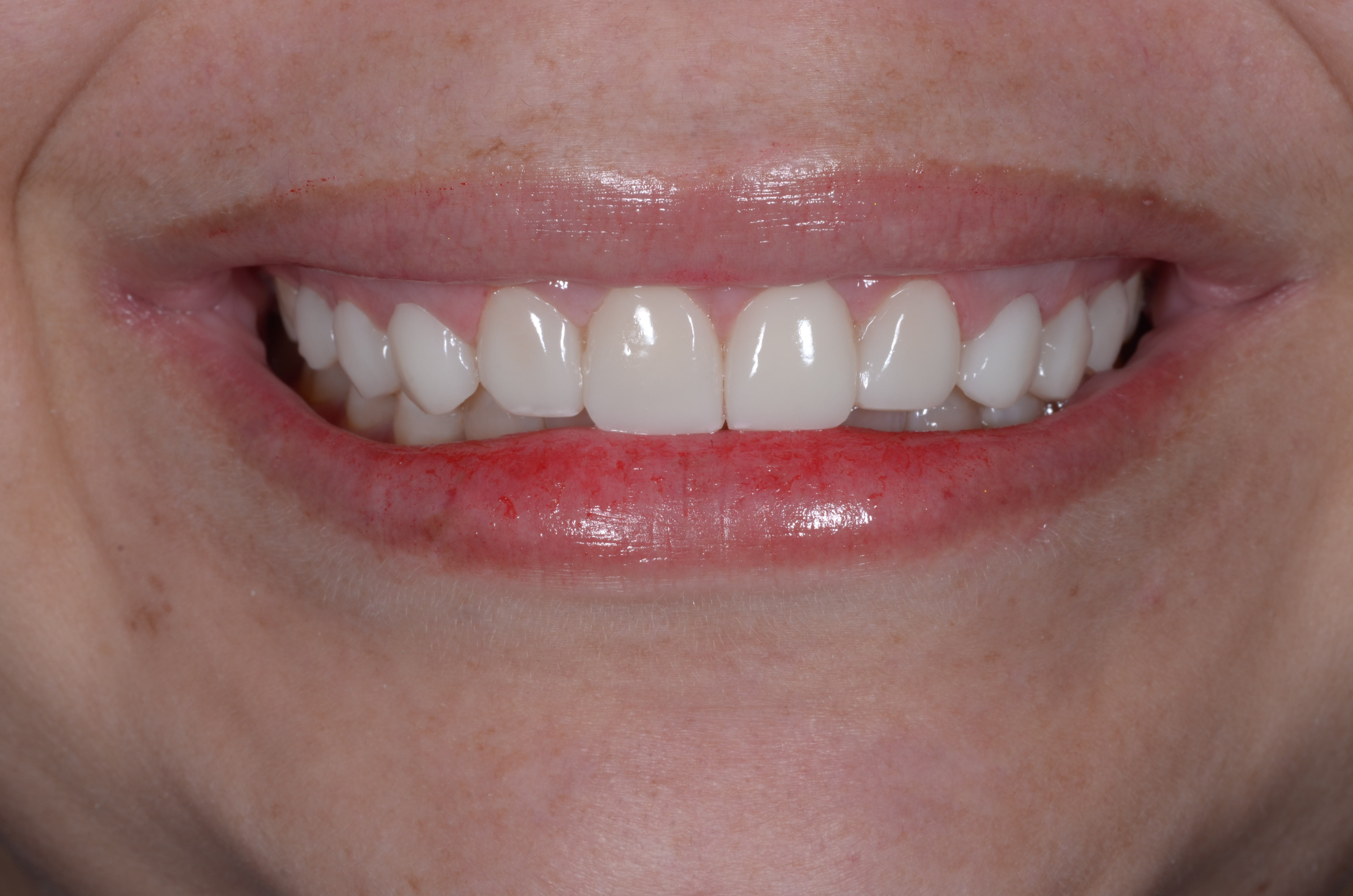 Después del tratamiento con disilicato