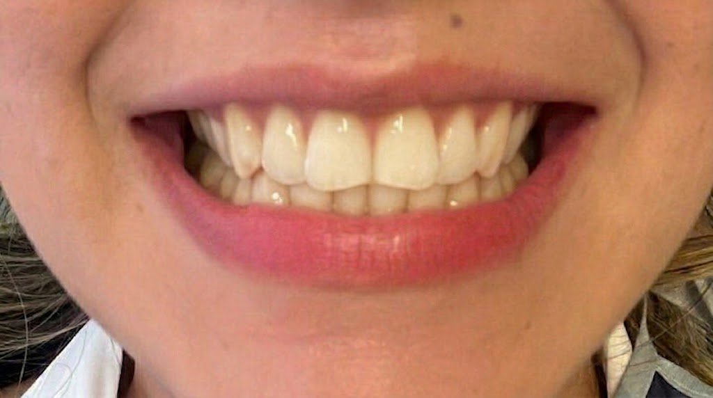Antes de blanqueamiento dental