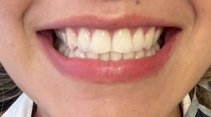 Después de blanqueamiento dental