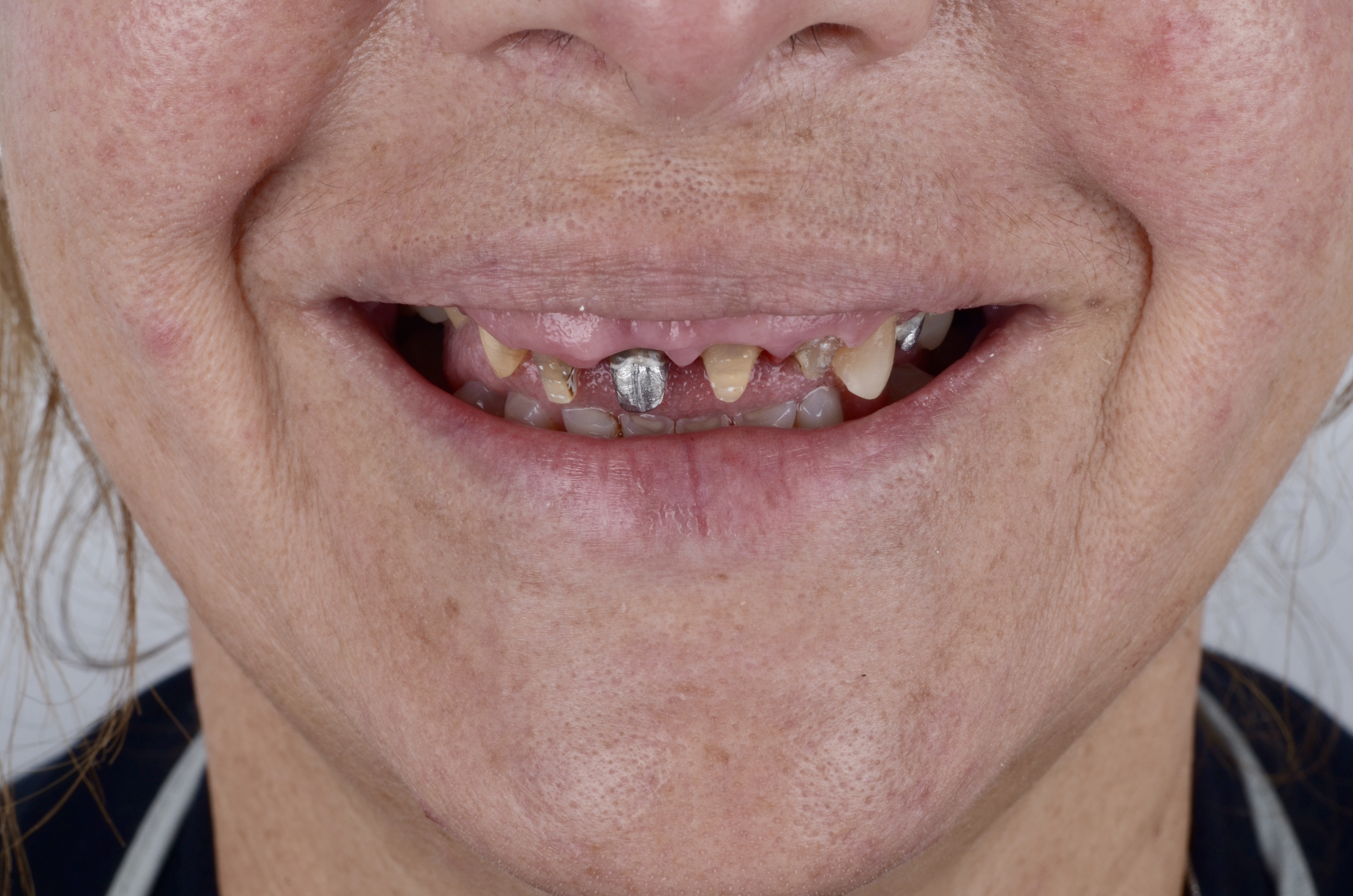 Antes de rehabilitación oral