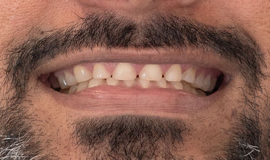Antes de diseño de sonrisa en disilicato