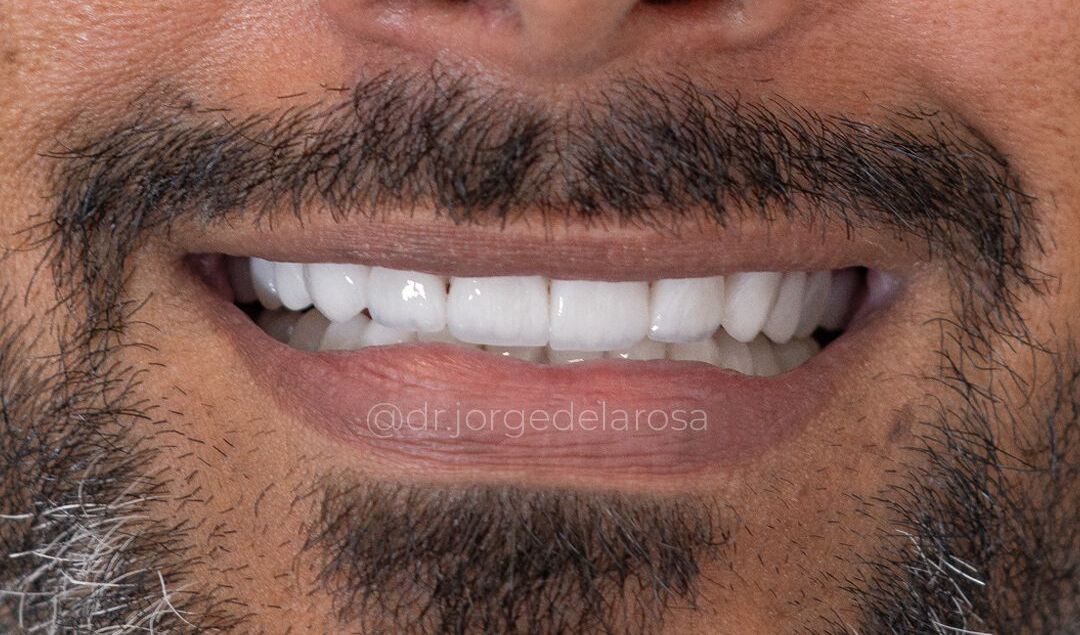 Después de diseño de sonrisa en disilicato