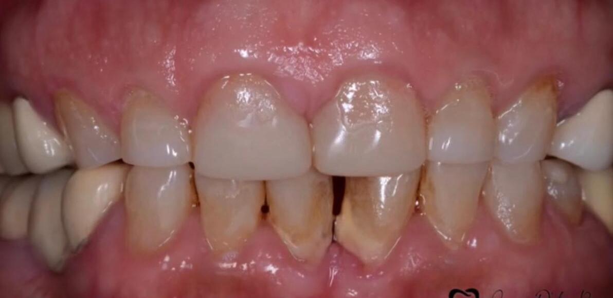 Después de limpieza dental profesional