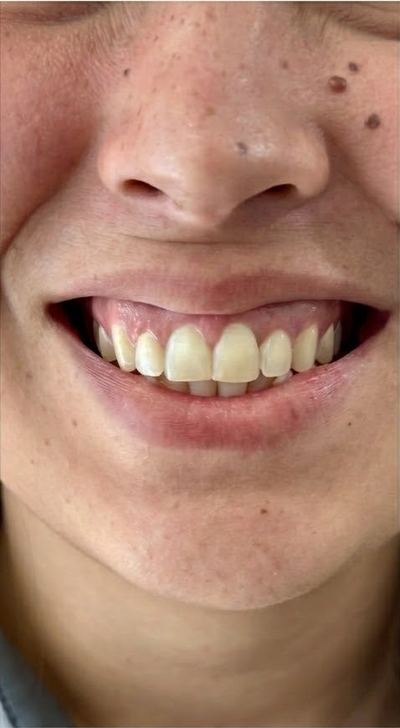 After orthodontic treatment