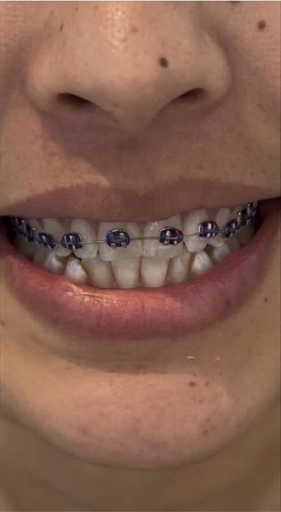 Before orthodontic treatment