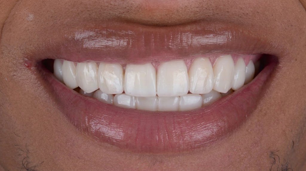 Después del diseño de sonrisa en resina